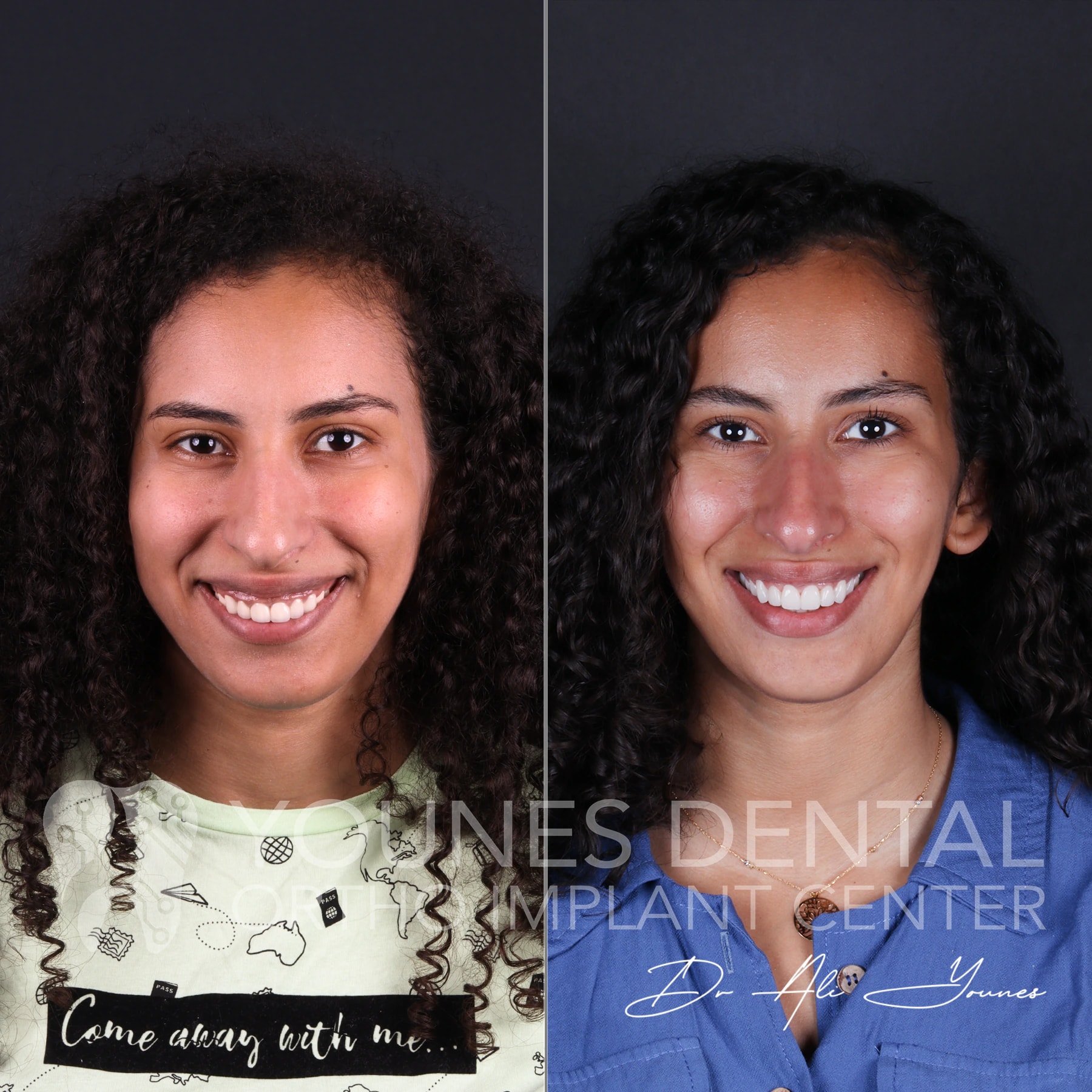 C&B & Gingivectomy — photo 1