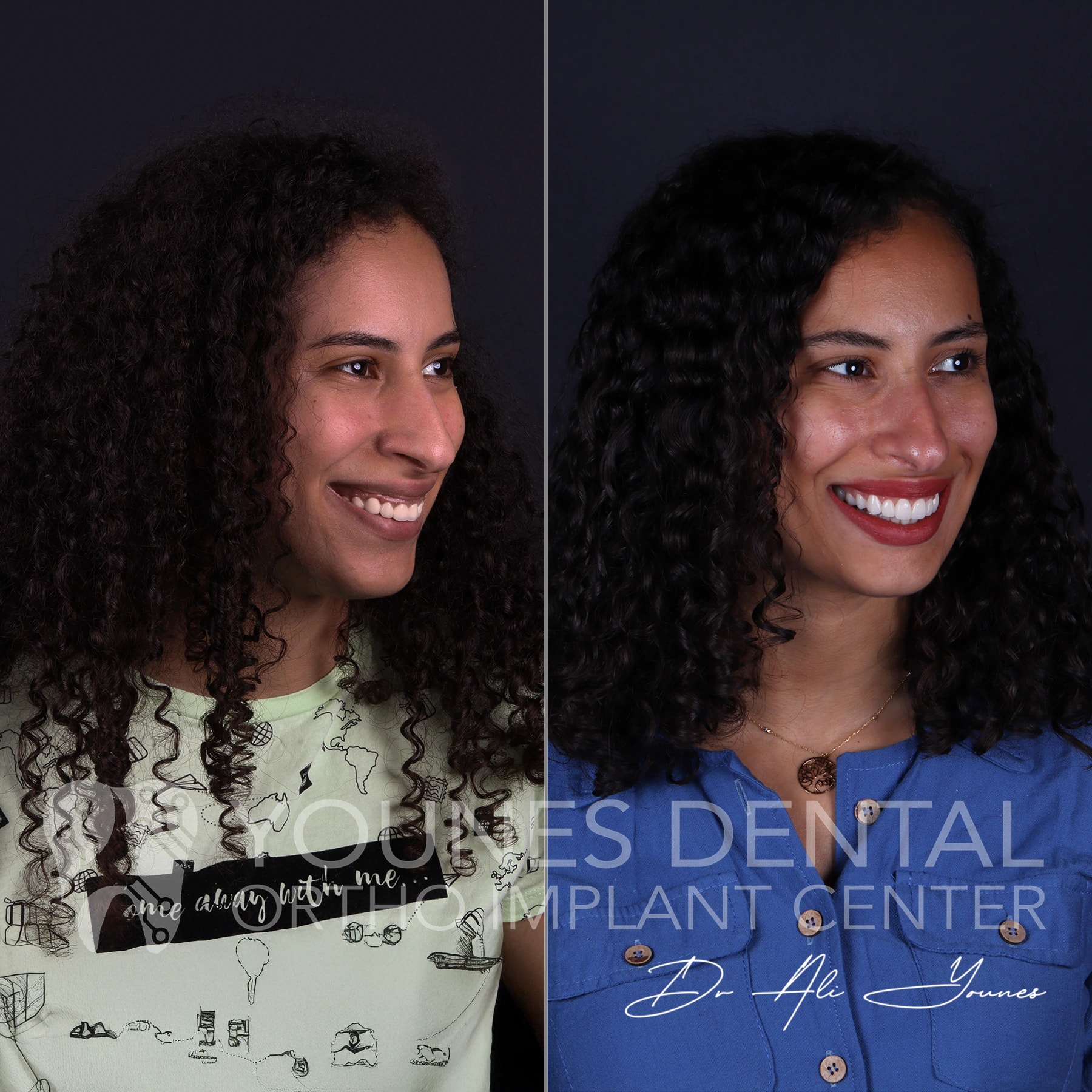 C&B & Gingivectomy — photo 2