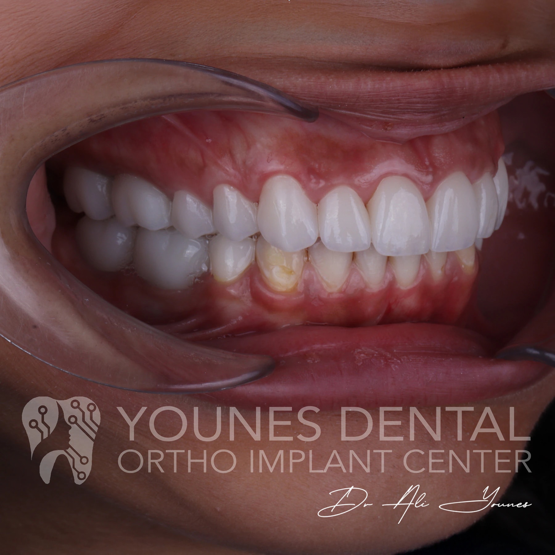 C&B & Gingivectomy — photo 6