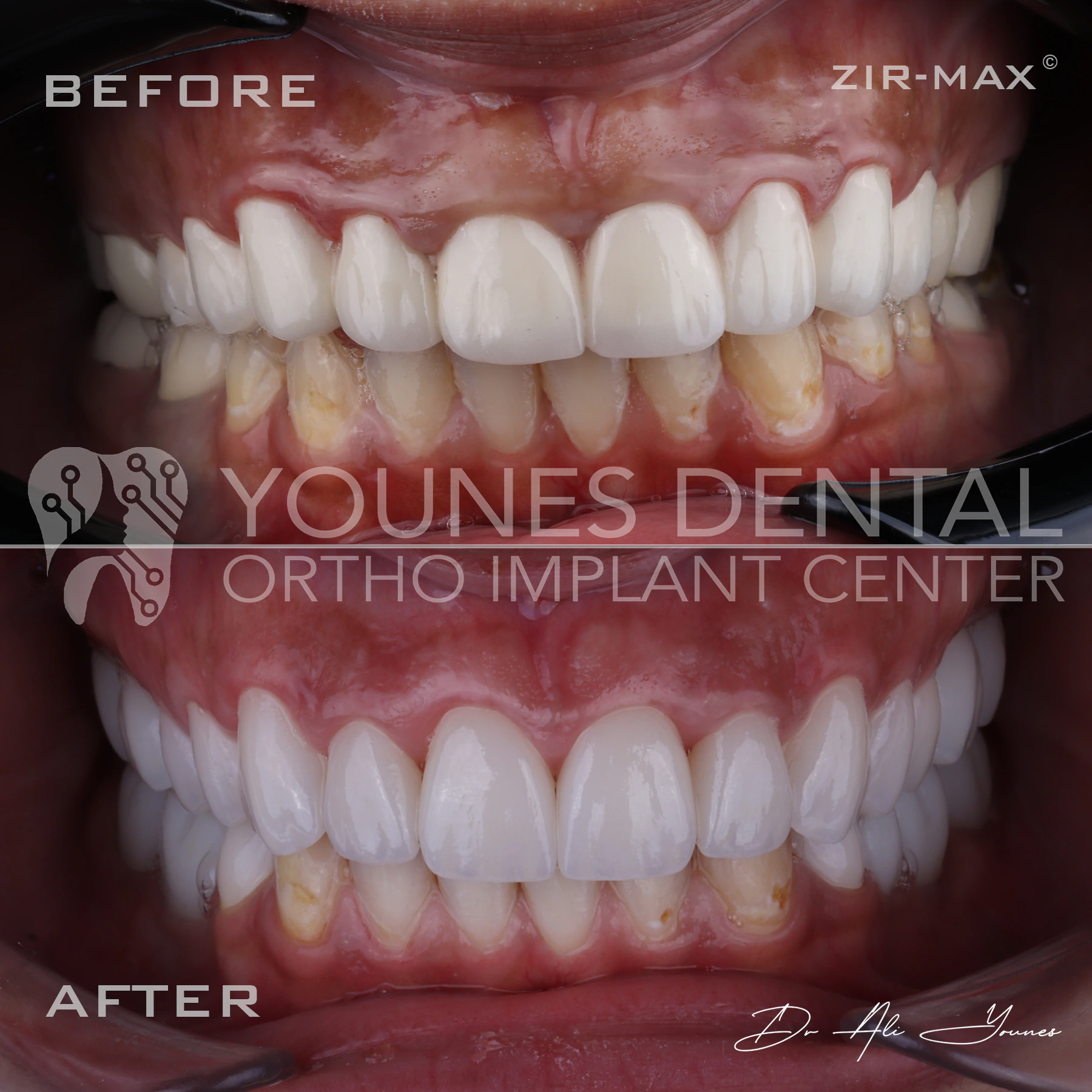 C&B & Gingivectomy — photo 3