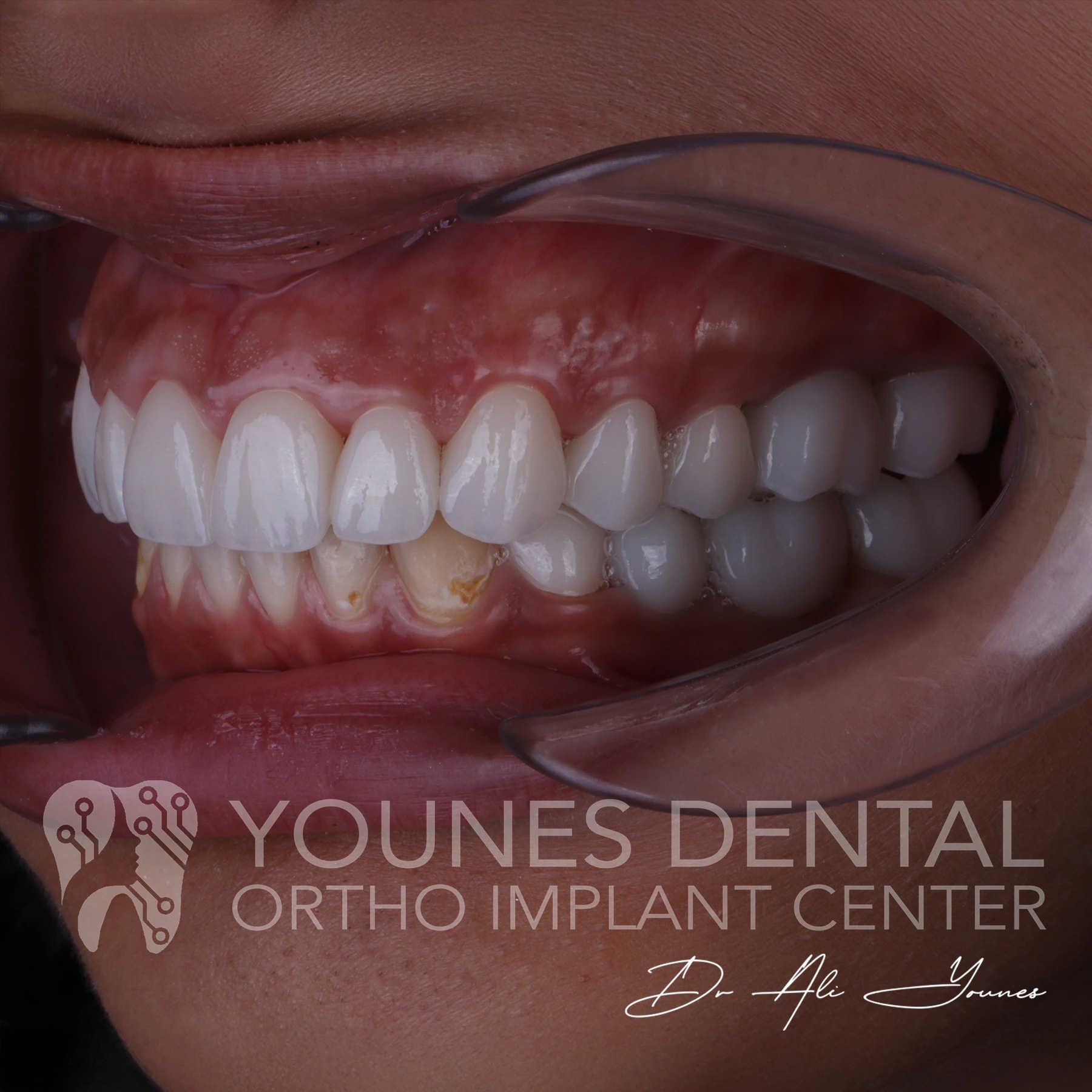 C&B & Gingivectomy — photo 5