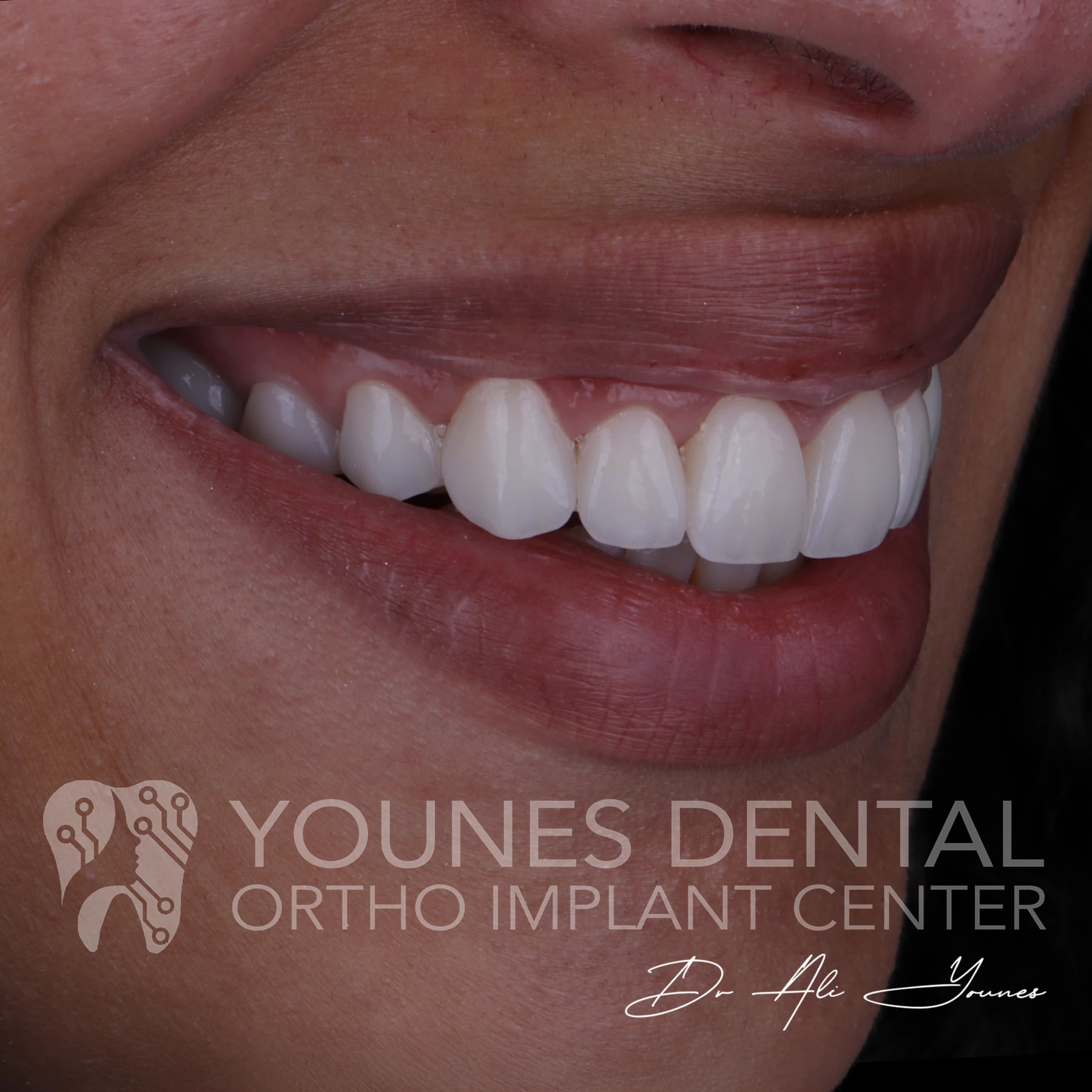 C&B & Gingivectomy — photo 9