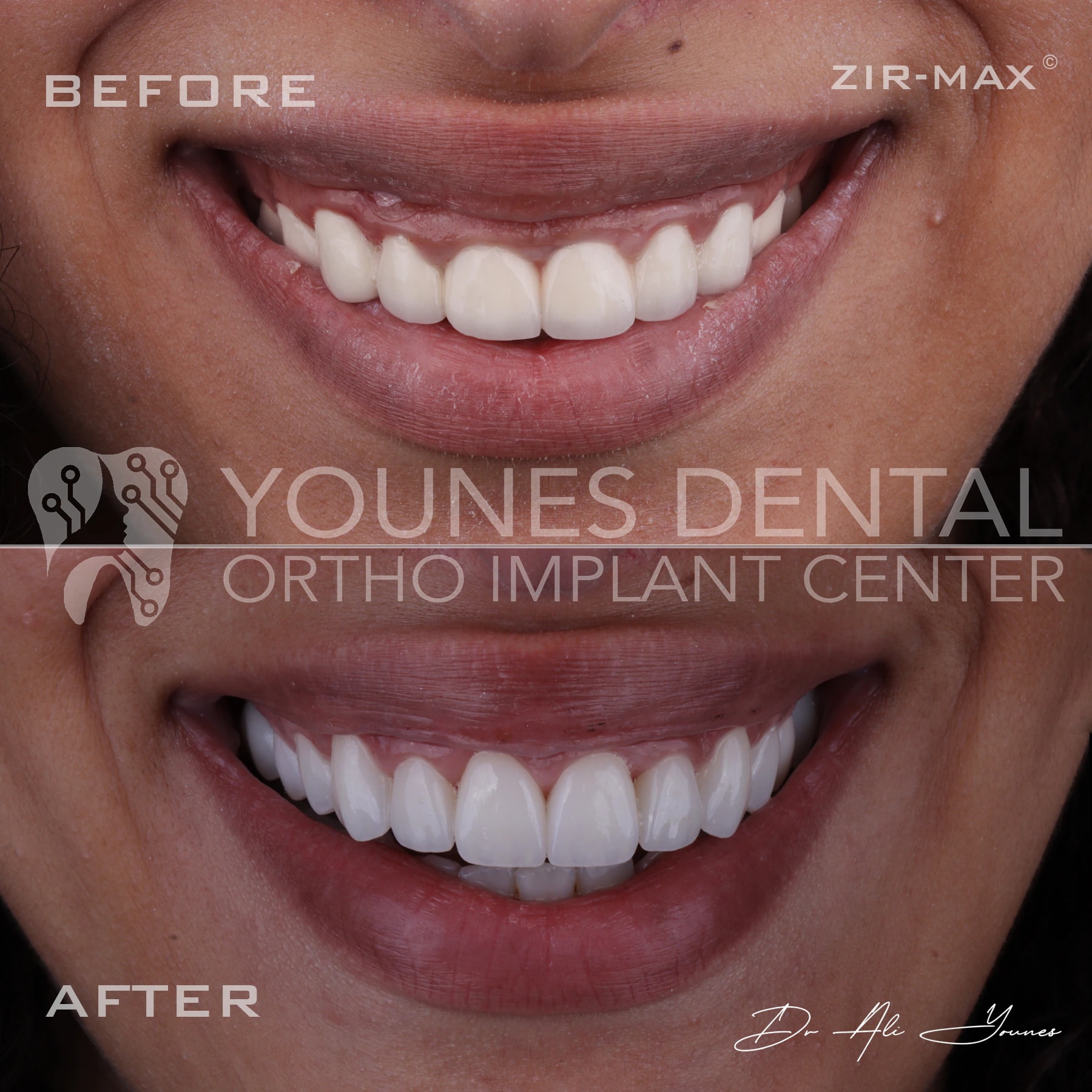 C&B & Gingivectomy — photo 4