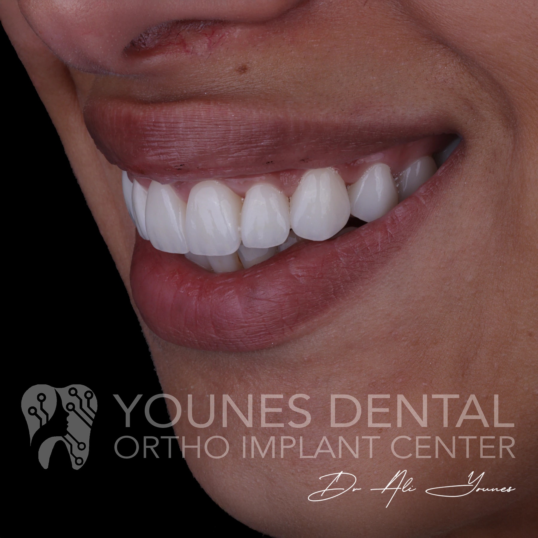 C&B & Gingivectomy — photo 10