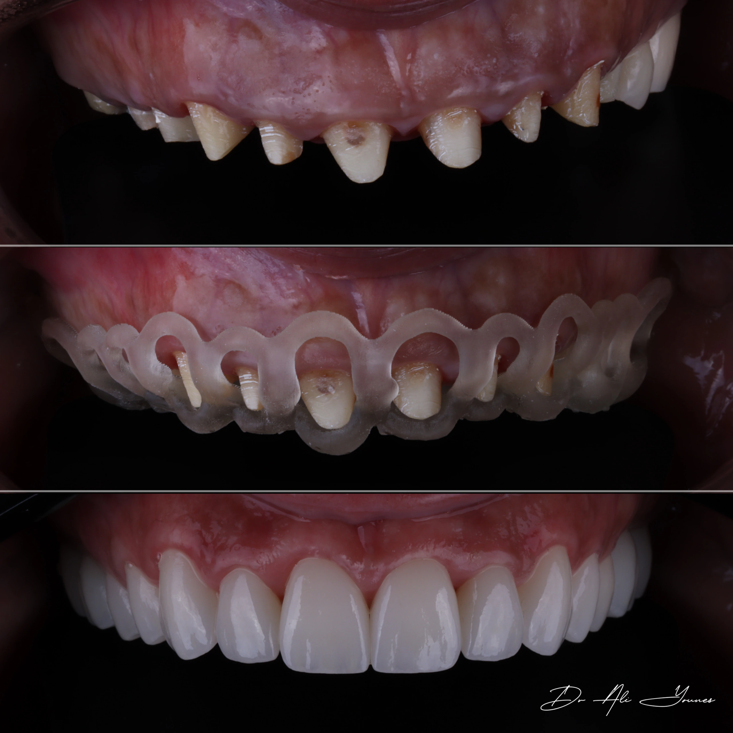 C&B & Gingivectomy — photo 7