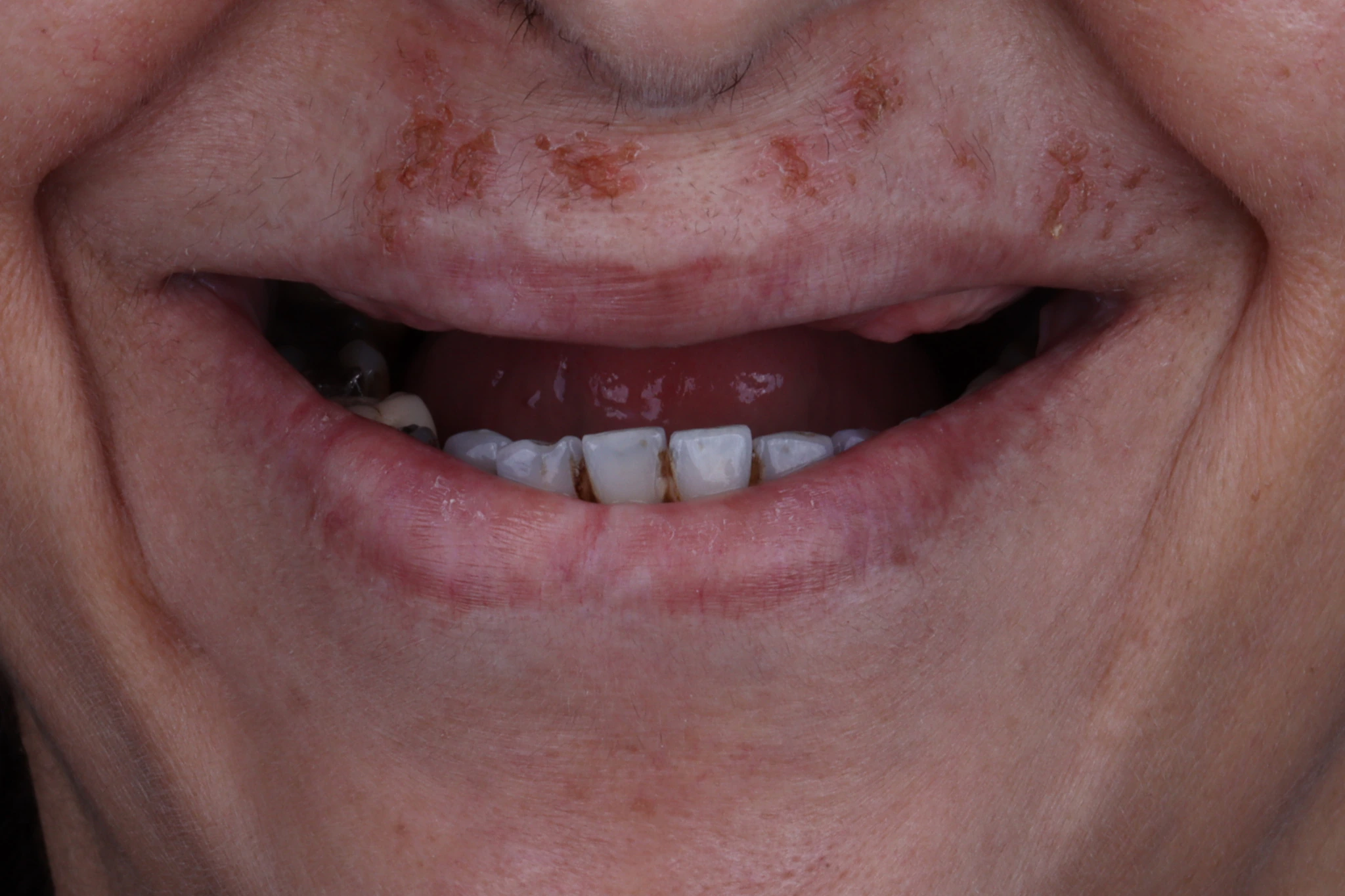 All on 4 — patient result — before