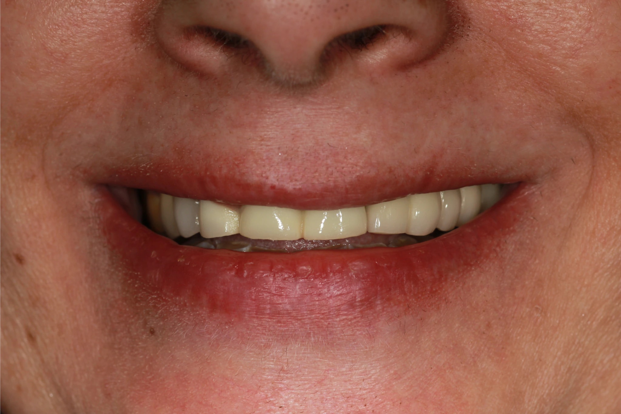 All on 4 — patient result — before