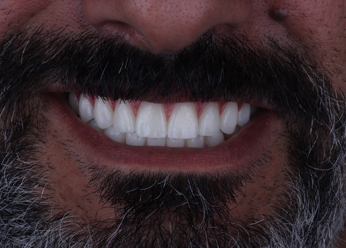 All on 4 — patient result — after