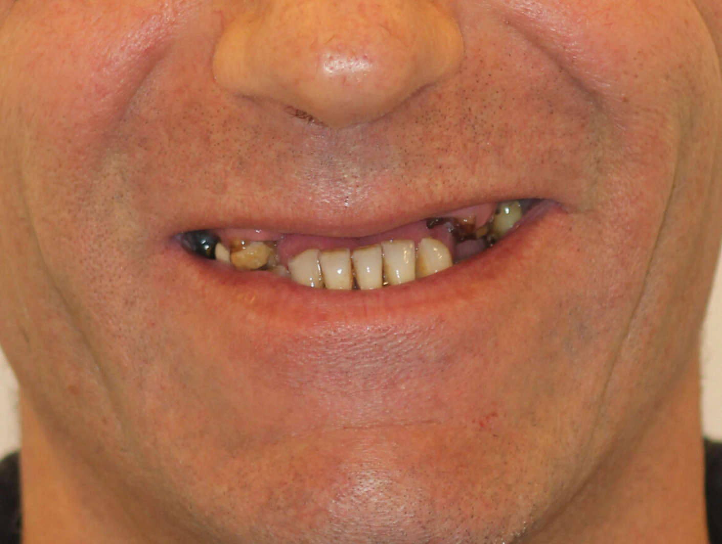 All on 4 — patient result — before