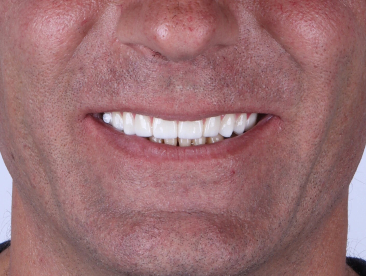 All on 4 — patient result — after