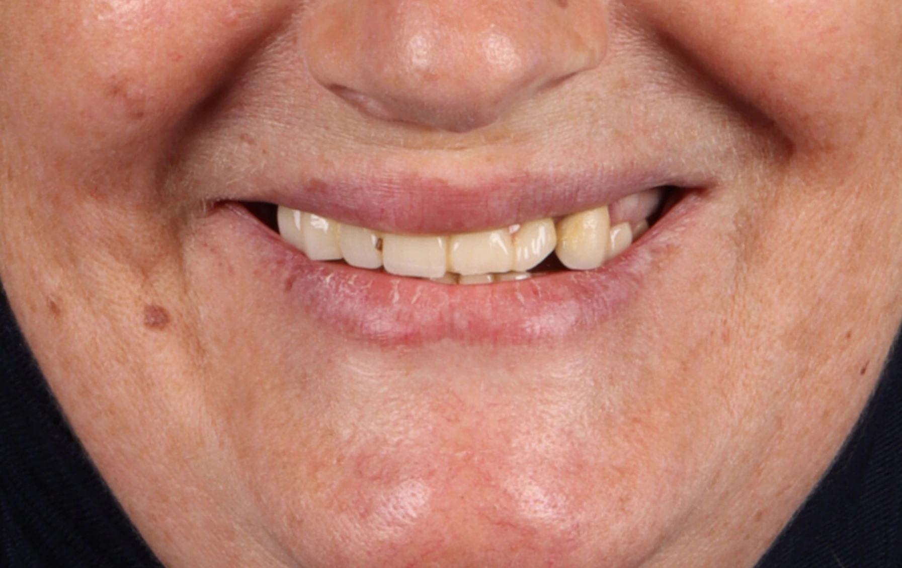 All on 4 & All on 5 — patient result — before
