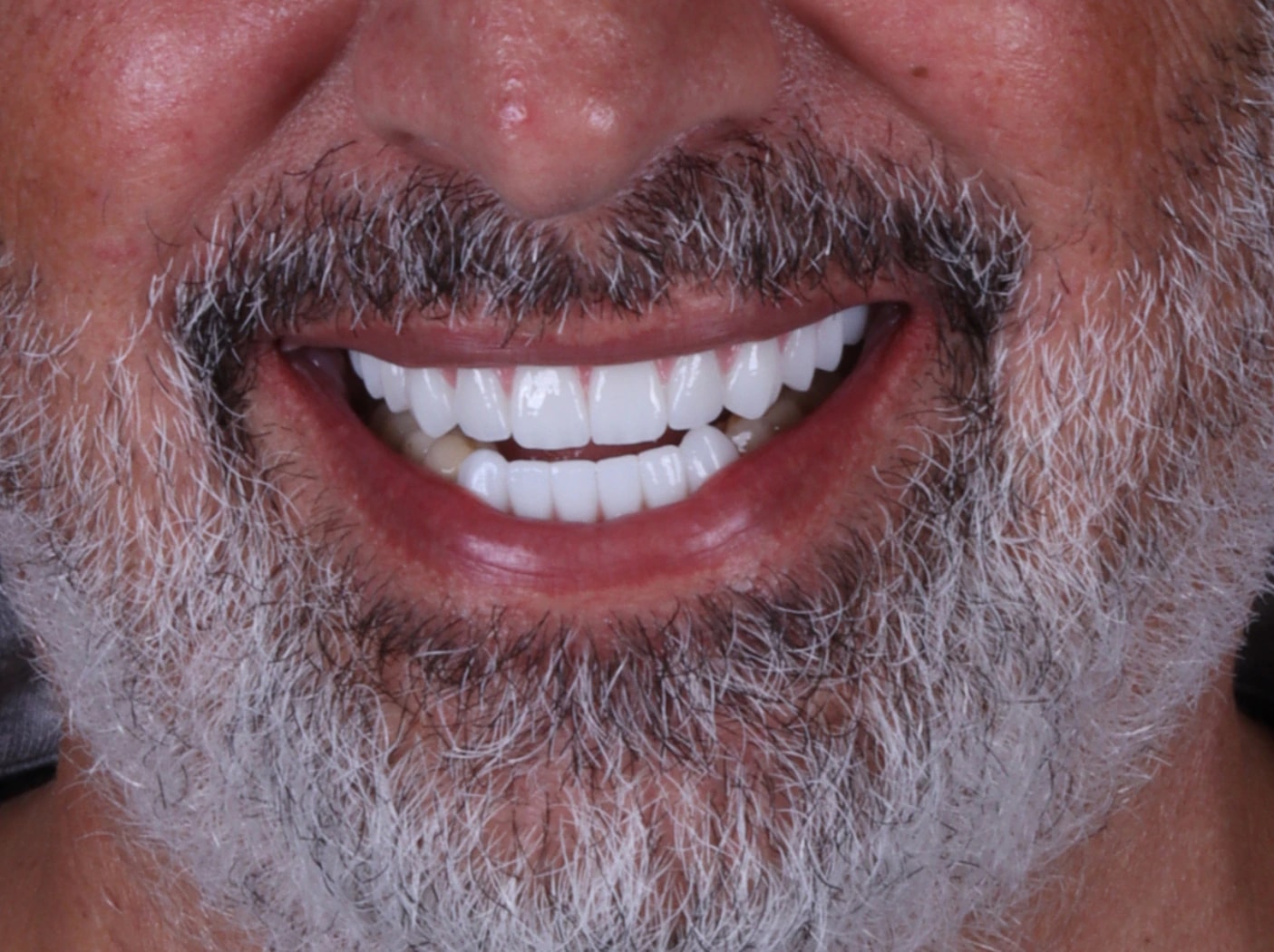 All on 4 — patient result — after