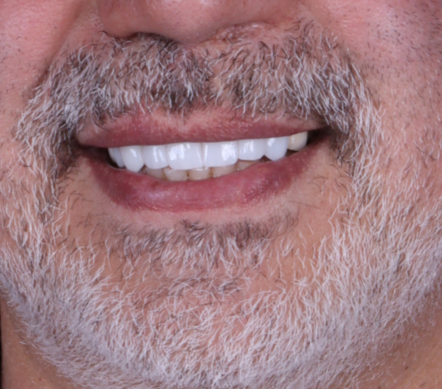 All on 3 — patient result — after