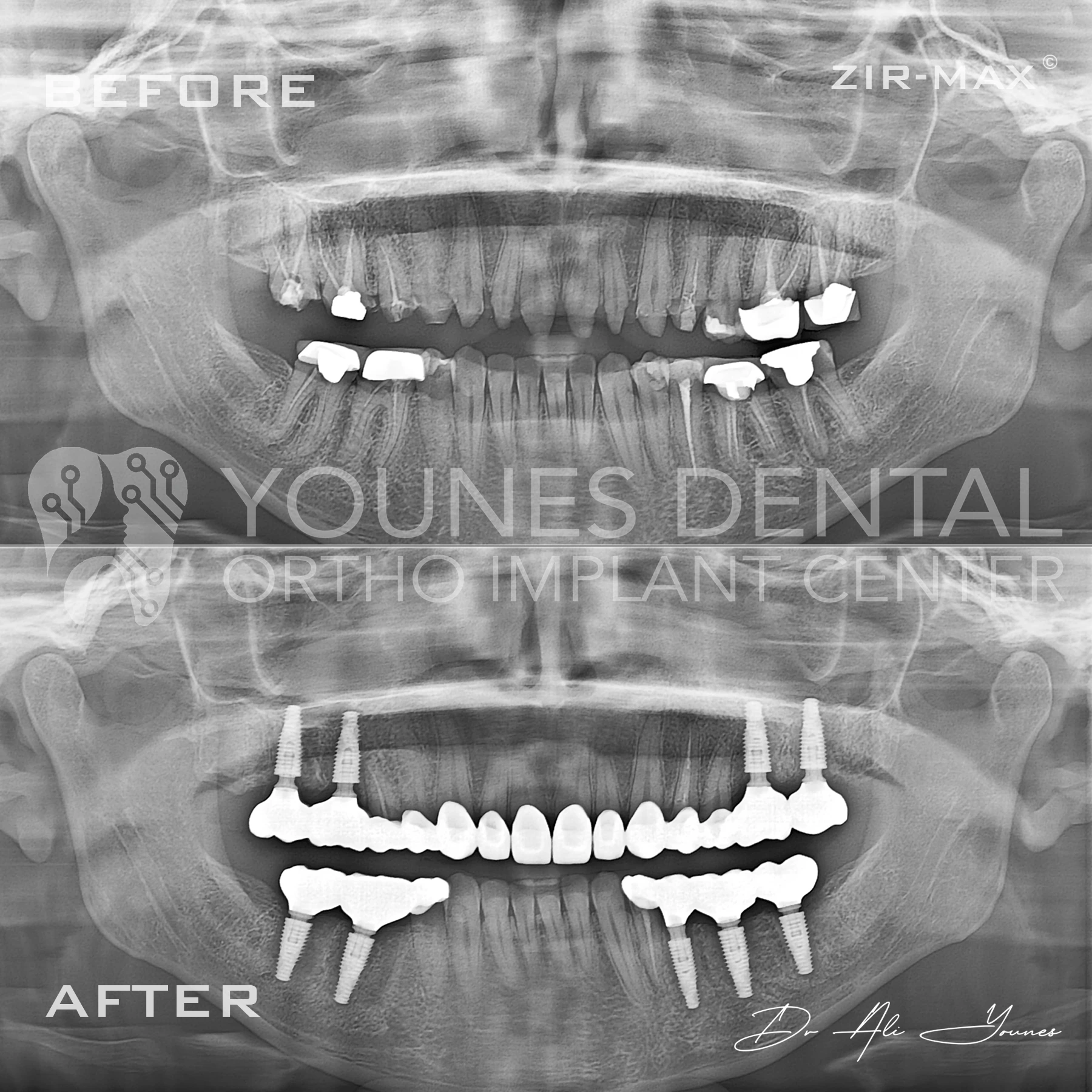 C&B & Gingivectomy — photo 8