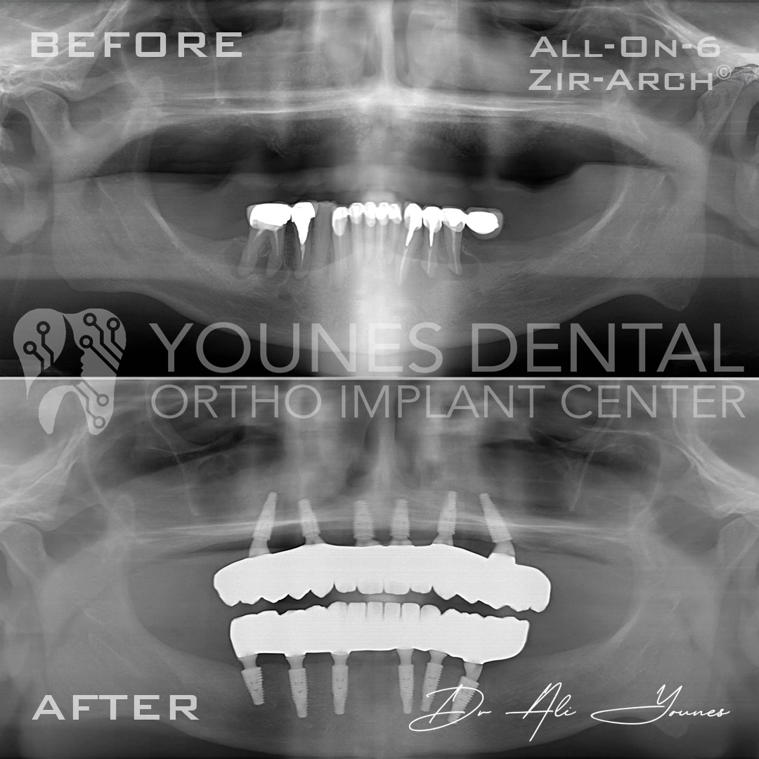 Panoramic radiographs of one patient before and after full-arch implant treatment