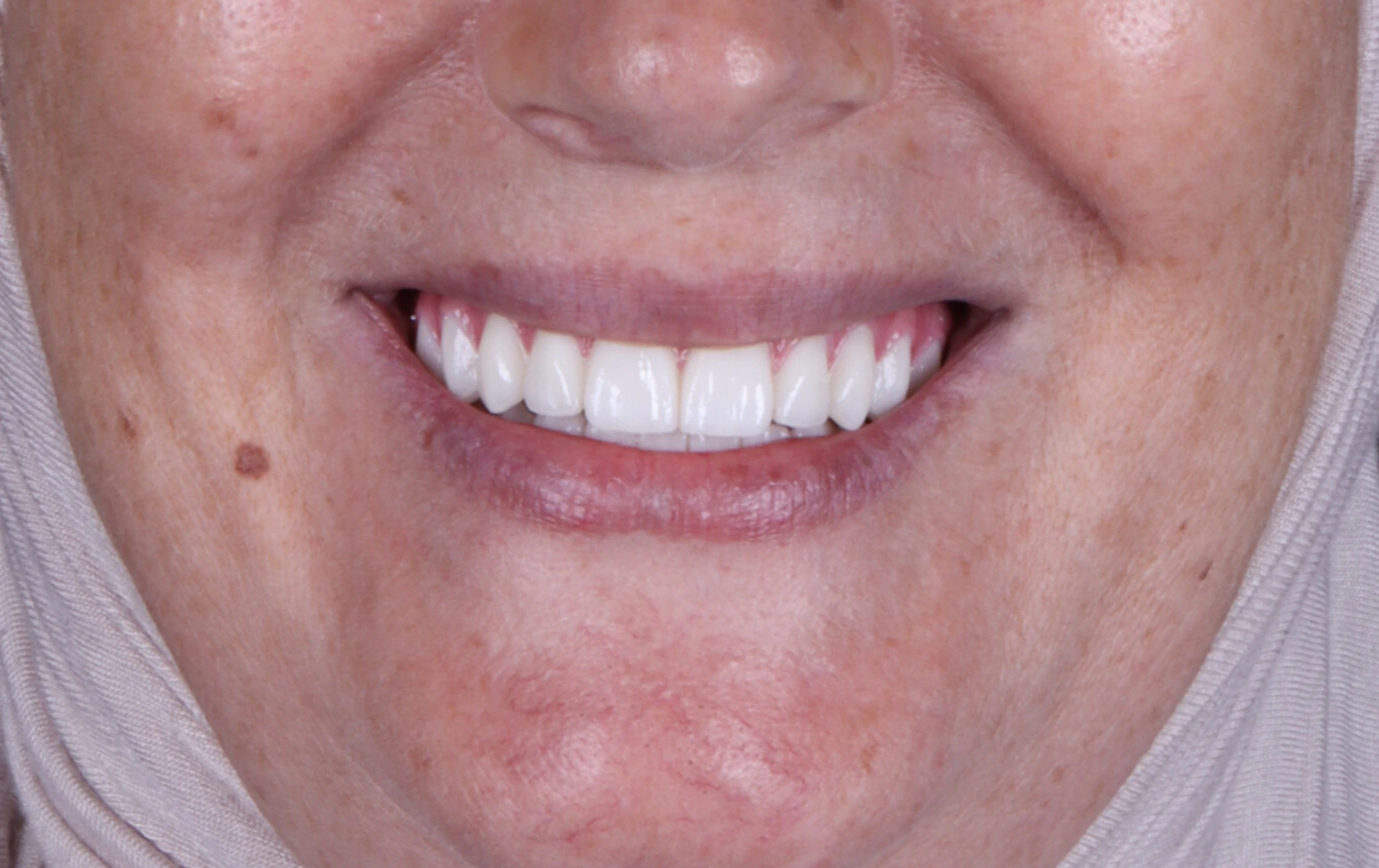 All on 4 & All on 5 — patient result — after