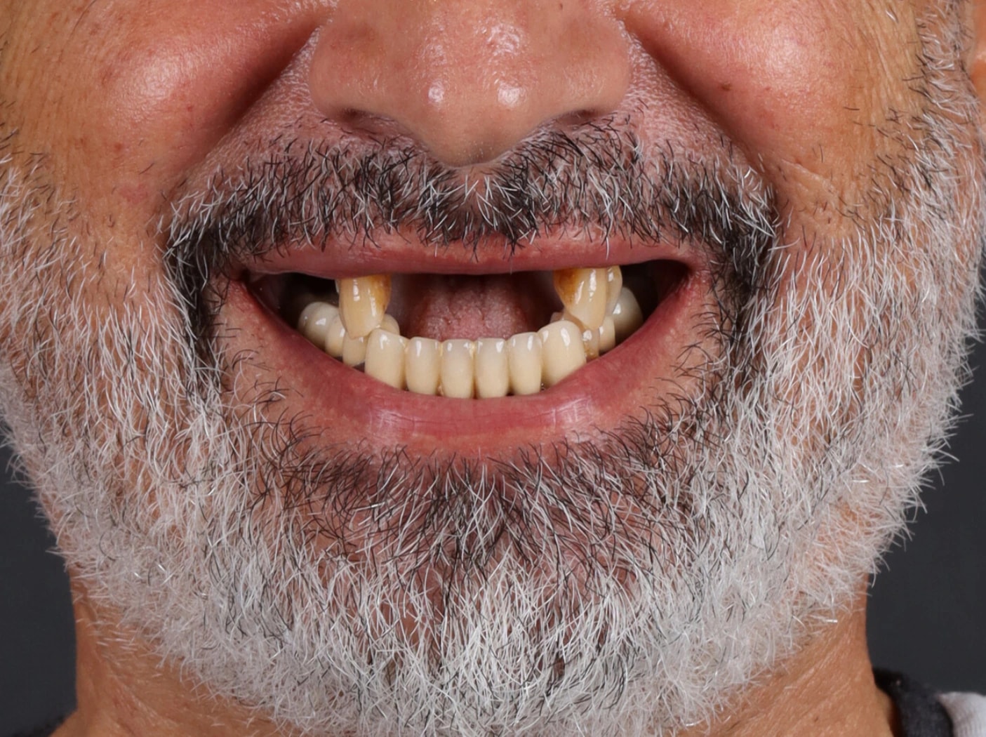 All on 4 — patient result — before
