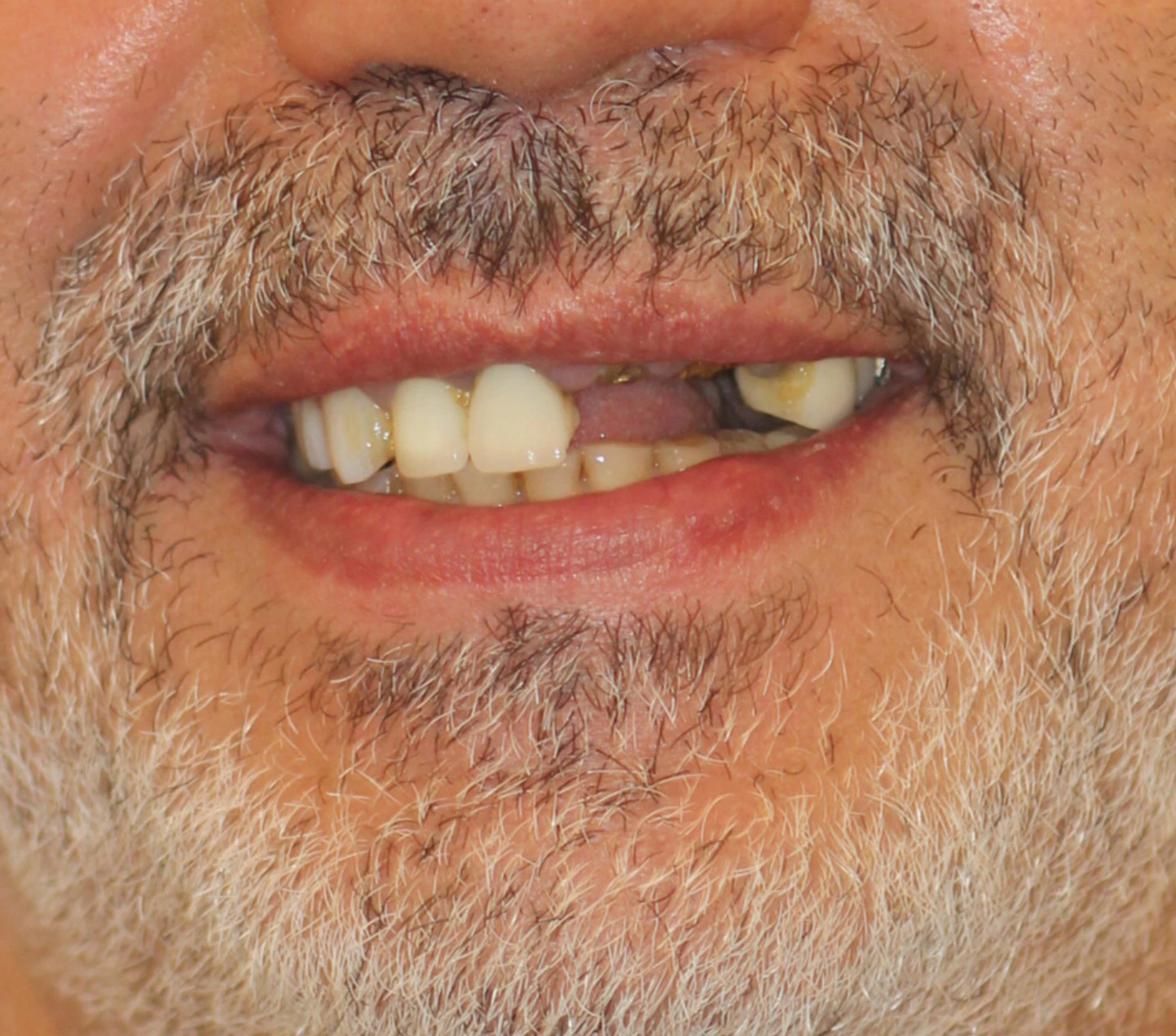 All on 3 — patient result — before