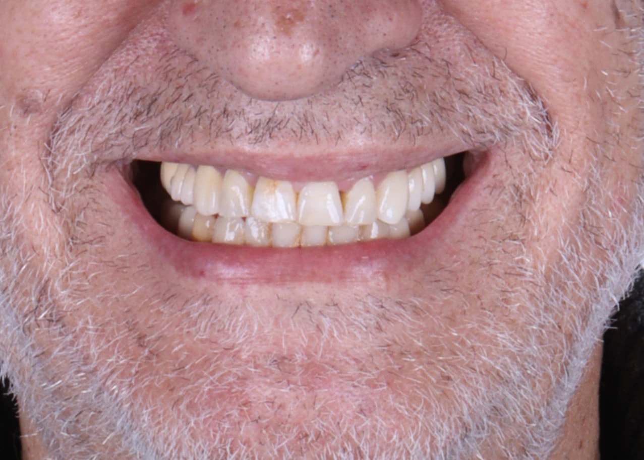All on 3 — patient result — after
