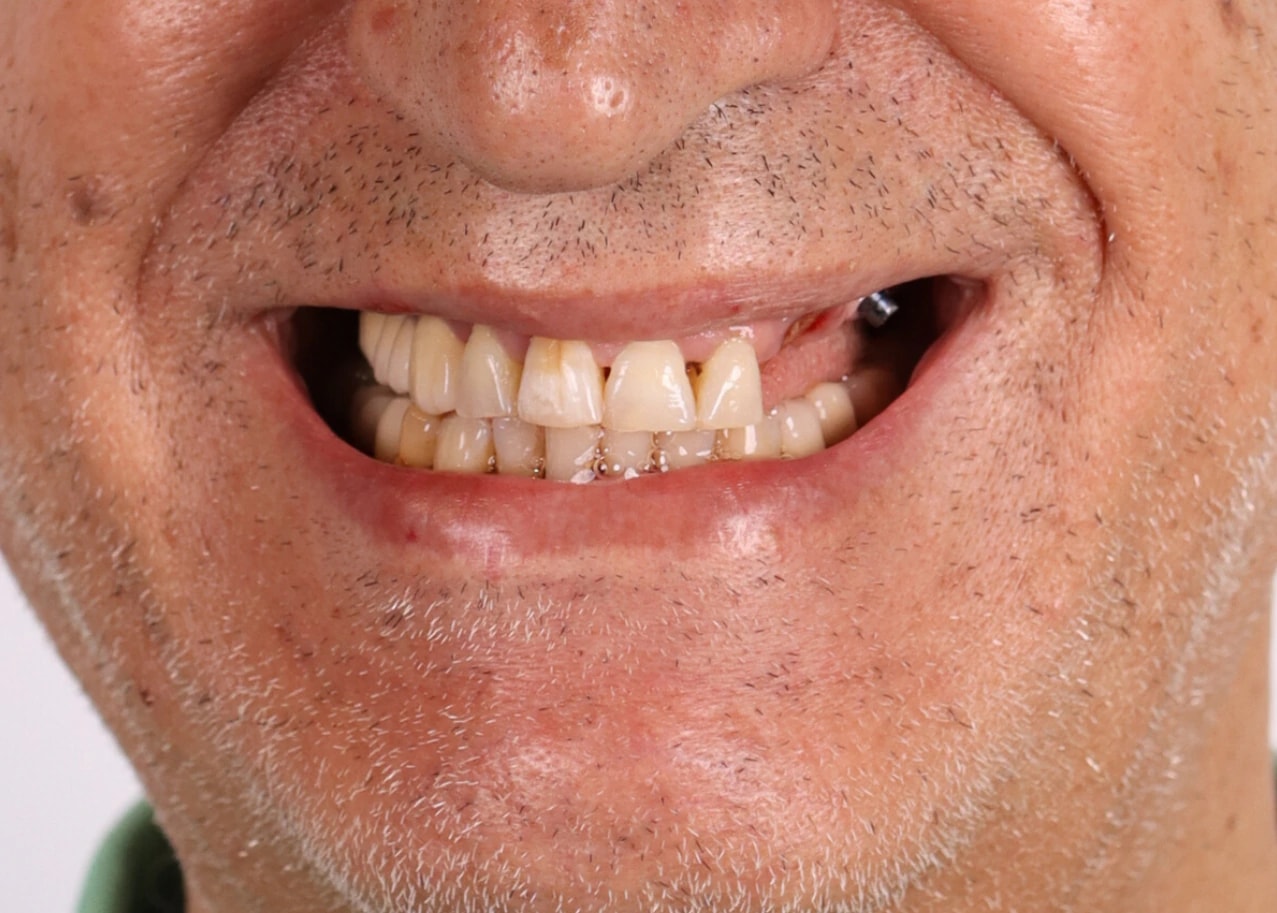 All on 3 — patient result — before
