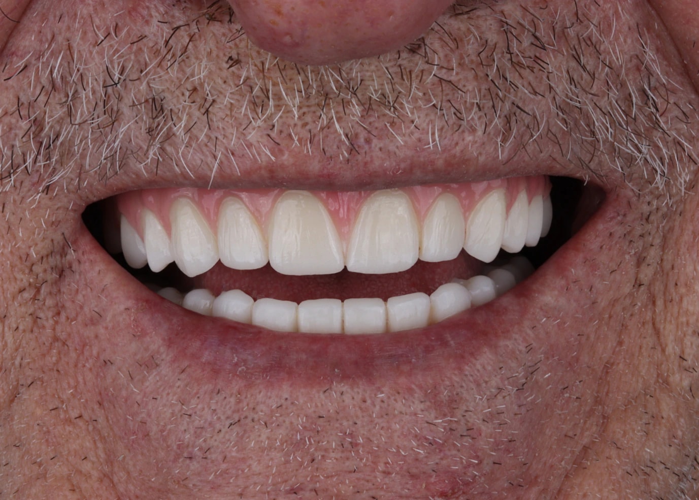 All on 6 — patient result — after