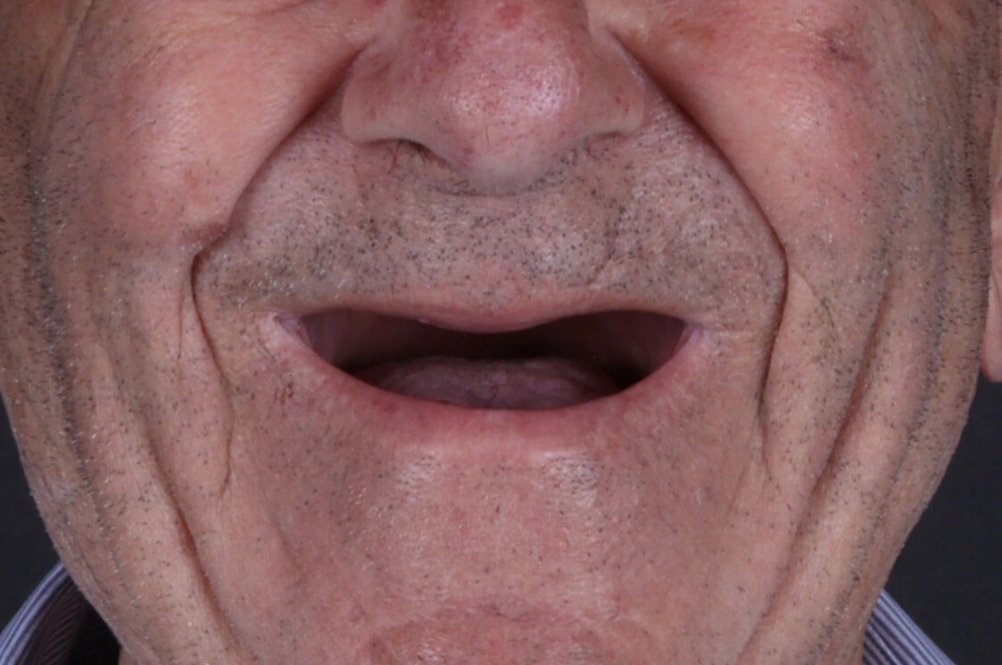 All on 4 — patient result — before
