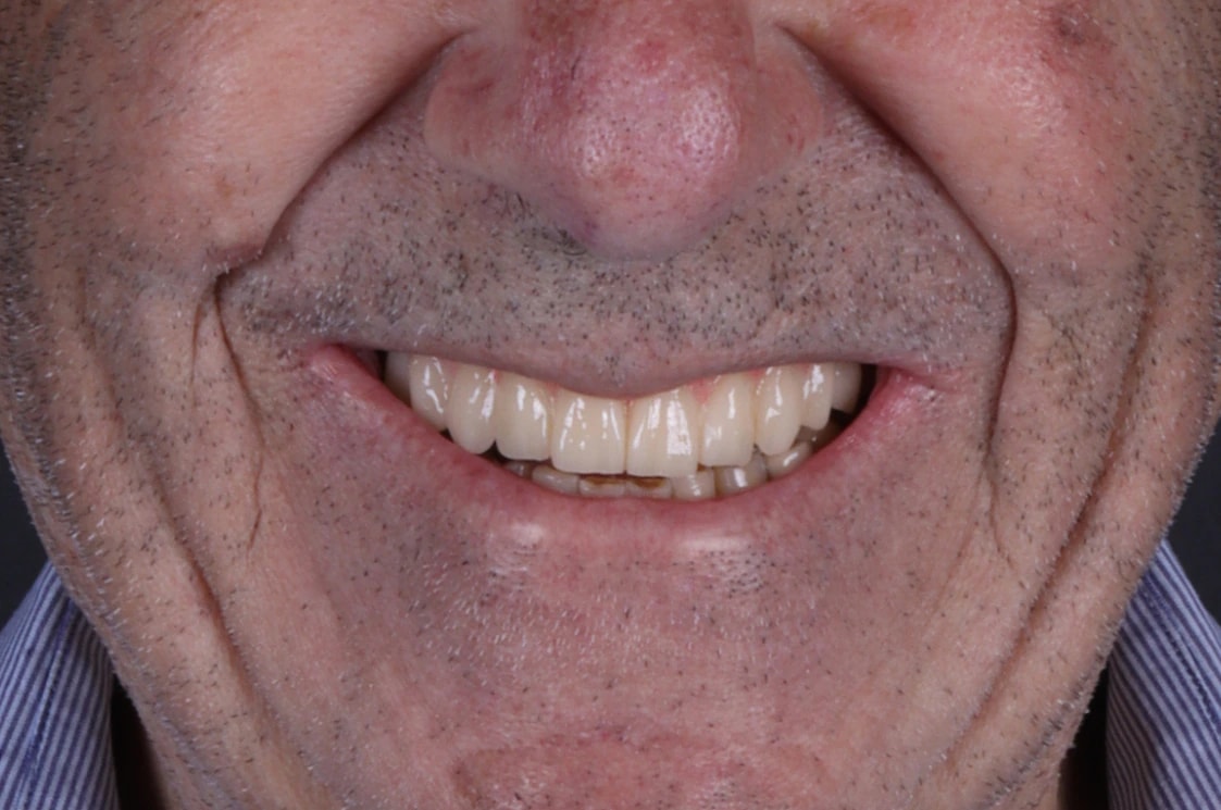 All on 4 — patient result — after